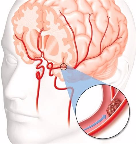 What to Know and Do When Your Brain Has Blood Clots | New Health Advisor