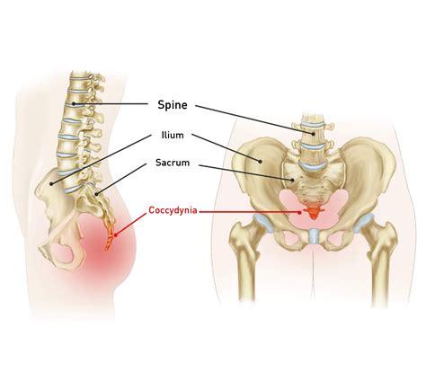 Coccyx Pain Causes