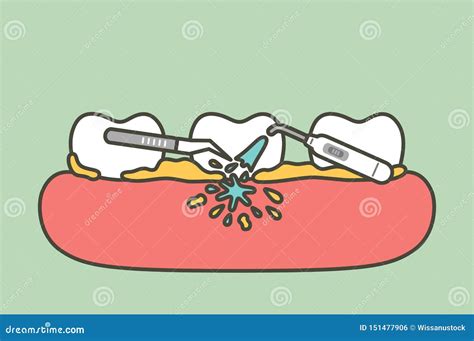 Teeth Scaling, Dental Plaque Removal for Cleaning Stock Vector ...