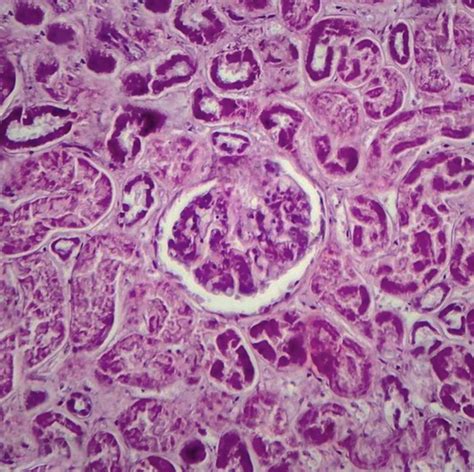 [Figure, Histology of diffuse proliferative glomerulonephritis ...