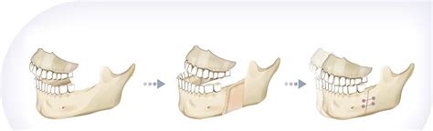 How To Fix A Crooked Jaw Without Surgery