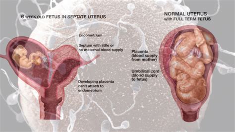 FANEOTRICS 2019: Bicornuate Uterus