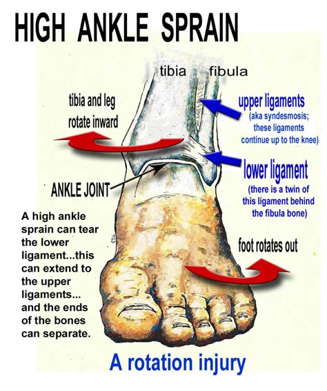 High Ankle Sprain - Motus Physical Therapy