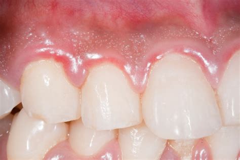 How to Get Rid of Gingivitis: Treatment for Bleeding Gum Disease | Diet vs Disease