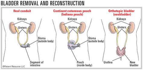 Bladder Cancer Reconstruction