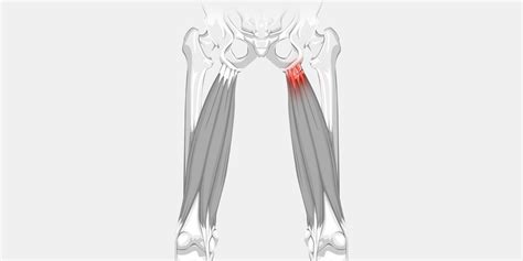 Hamstring Tendonitis - The Complete Injury Guide - Vive Health