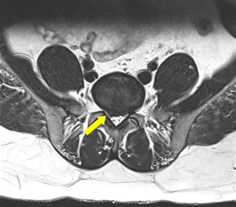 Cureus | Inferior Mesenteric Artery Injury in Post-lumbar Microdiscectomy: A Case Report