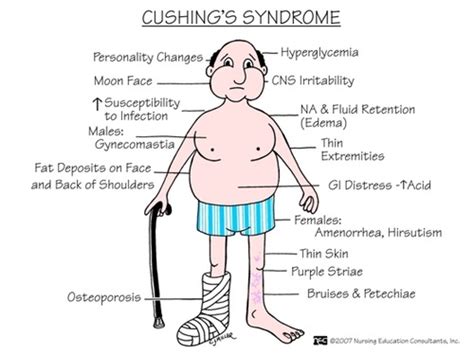 Cushing's syndrome and Addison's disease Flashcards | Quizlet