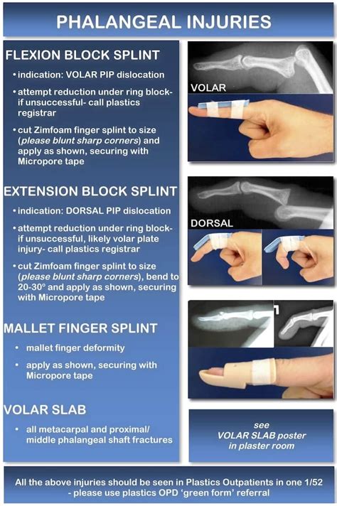 Volar Finger Splint