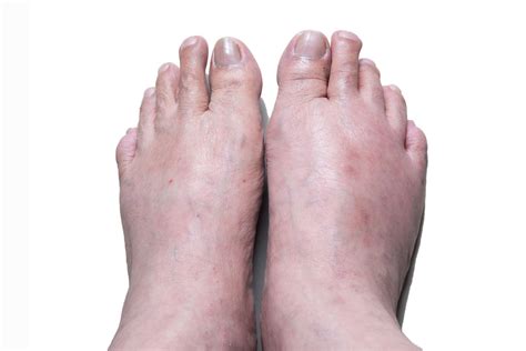 Gout: Symptoms, Pictures, Treatment, and More