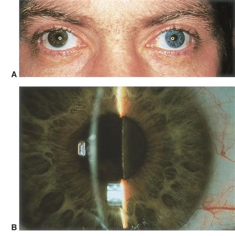 Siderosis bulbi - American Academy of Ophthalmology