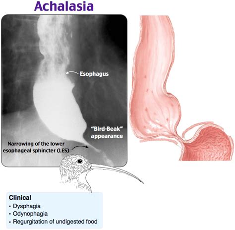 Rapid Review: Achalasia - RoshReview.com