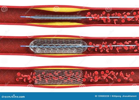 Balloon Angioplasty Procedure Stock Illustration - Illustration of erythrocyte, catheter: 159083228