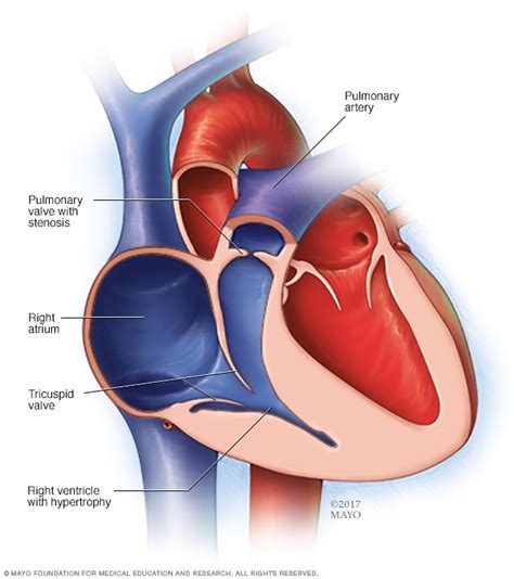 Pulmonary stenosis - Mayo Clinic