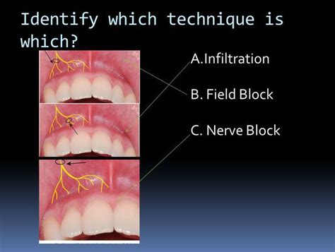 Local Anesthetic Injection Techniques - MEDizzy