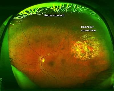 Retinal Hole Laser Treatment in Singapore: A Guide on How To Fix ...