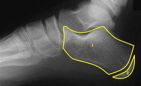 Severs Disease (Calcaneal Apophysitis) - Ankle, Foot and Orthotic Centre