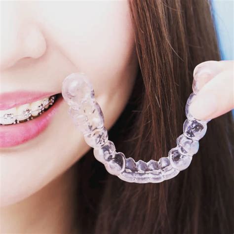 Owning Your Own Invisible Aligners - As Easy As ABC - Espoletta