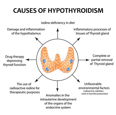 Hypothyroidism Vector Illustration. Labeled Underactive Thyroid ...