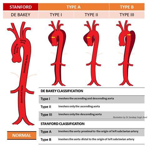 Stanford and DeBakey classifications of aortic dissection. | Download Scientific Diagram