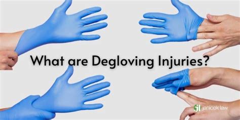 San Antonio Degloving Lawyer | Degloving Injuries San Antonio