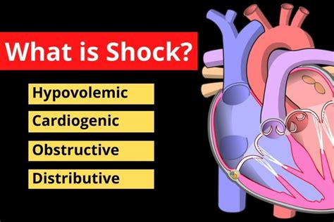 Differences between compensated, decompensated and irreversible shock