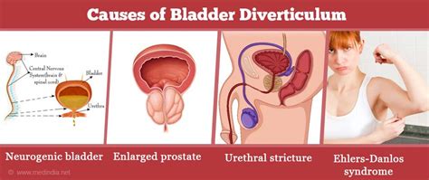 Bladder Diverticulum - Causes, Symptoms, Diagnosis and Management