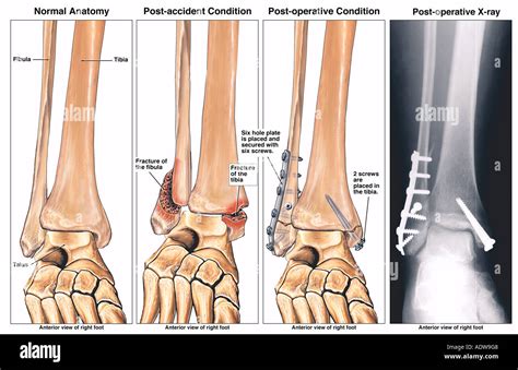 Xknee Startradiology Ankle Fracture Neck Fracture