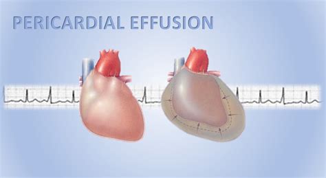 Pericardial Effusion - Causes, Symptoms, Diagnosis, Prognosis, Treatment