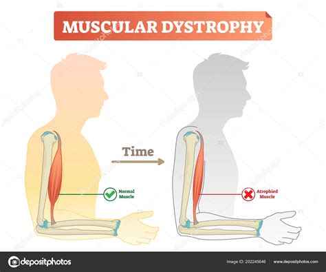 Vector illustration about muscular dystrophy. Compared normal muscle ...