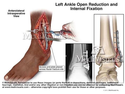 Left Ankle Open Reduction and Internal Fixation | Custom illustration, Illustration, Litigation