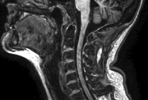 Cervical Spine Ms Lesions On Mri