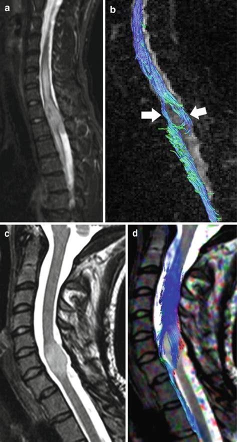 Spinal Cord Tumors: Anatomic and Advanced Imaging | Radiology Key