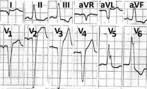 Understanding Septal Infarct: Causes, Symptoms, Diagnosis, and Treatment - Leaksnation