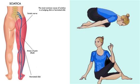 9 Yoga Poses for Sciatica Pain Relief