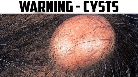 Pilar Cysts, Scalp Cysts, Trichilemmal Cyst Excision - YouTube