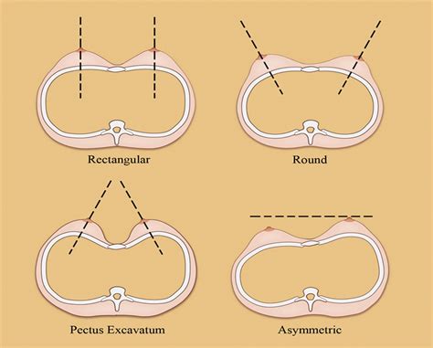 Breast Augmentation : Plastic and Reconstructive Surgery