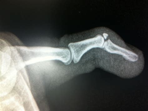 Mallet Fracture Surgery at Benjamin Wayt blog