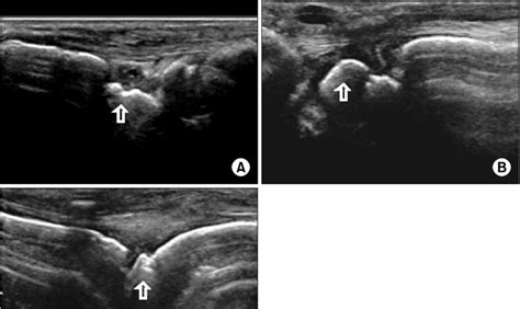 F/U ultrasonography of both wrists still showed synovial hypertrophy ...