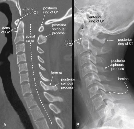 Imaging the Cervical, Thoracic, and Lumbar Spine | Radiology Key