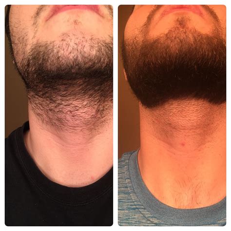 Minoxidil Beard Reddit Before And After Pictures | Beard Style Corner