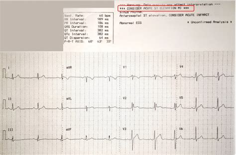 Dr. Smith's ECG Blog: RSR' with ST elevation: is this Right Bundle ...