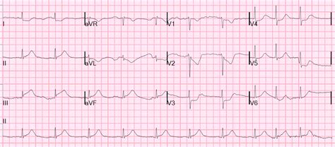 Dr. Smith's ECG Blog: STEMI with Life-Threatening Hypokalemia and ...