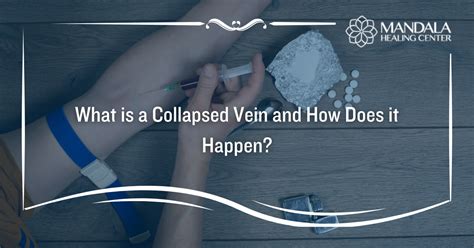 What is a Collapsed Vein? - Mandala Healing Center