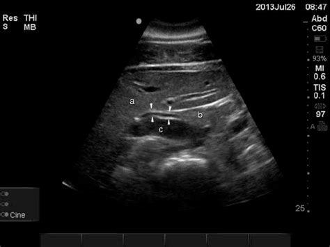 Longitudinal right-sided ultrasound image of the porta hepatis. The ...