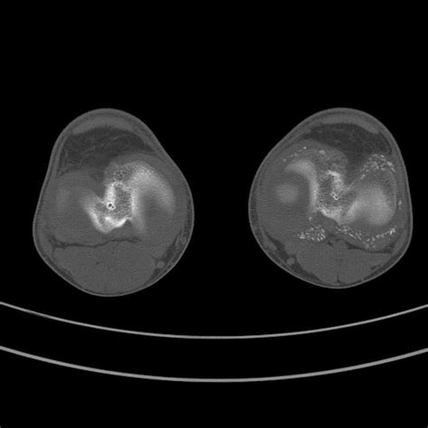 Synovial osteochondromatosis | Radiology Case | Radiopaedia.org ...