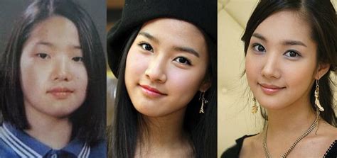 Park Min Young Plastic Surgery Before After