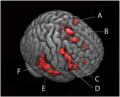 Omission-Activation of the Right Temporal Gyrus, across and between... | Download Scientific Diagram