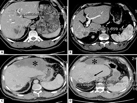 CT images showing changes in liver metastases: A — scan before ...