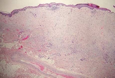 Desmoplastic Melanoma | MDedge Dermatology